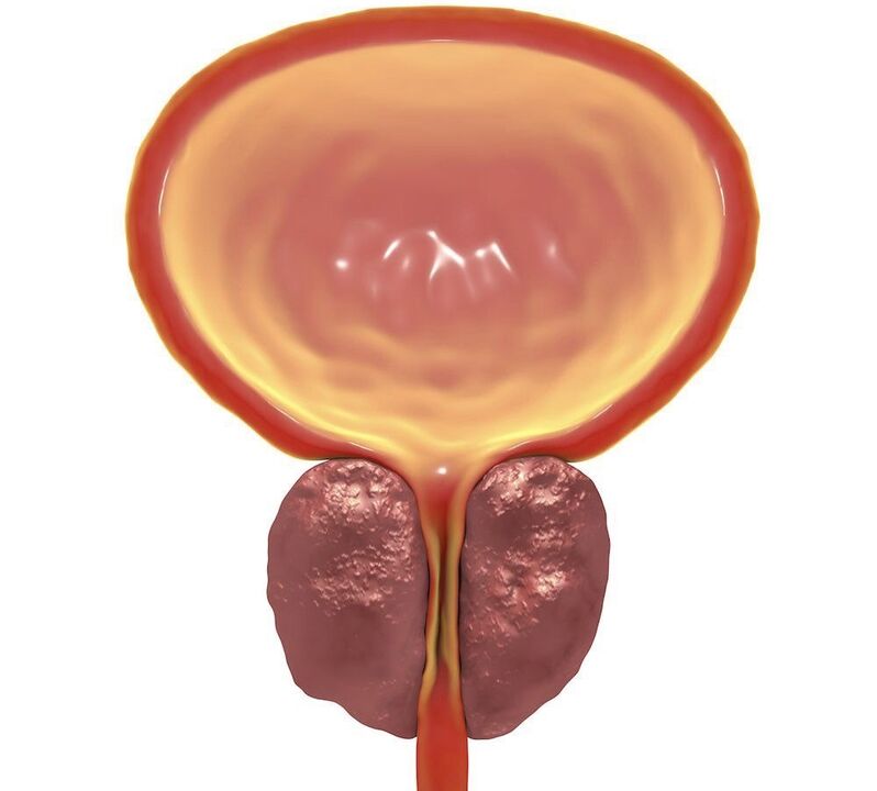 vnetje kroničnega prostatitisa