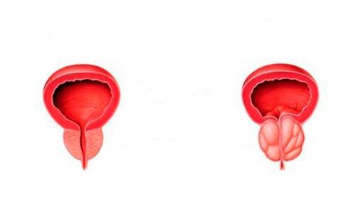 zdrava in vneta prostata s prostatitisom